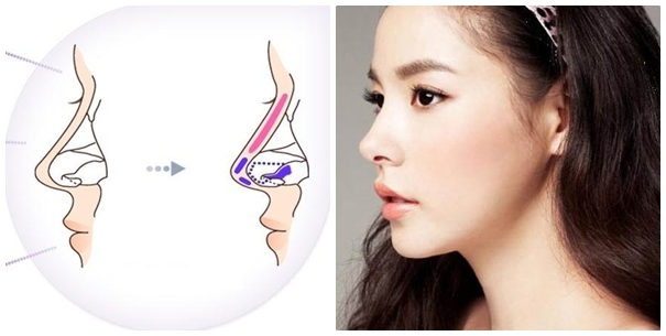 Hình ảnh người phụ nữ phẫu thuật hỏng lòi cả silicon mũi ra ngoài  Tin  tức Online