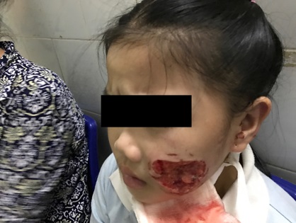bé gái 8 tuổi bị chó cắn nát mặt