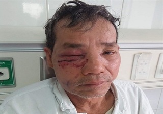 Tuyên Quang: Lâm tặc ném đá khiến một kiểm lâm bị thương nặng