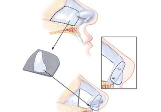 Nâng mũi cấu trúc 4D NanoForm mang lại dáng mũi bền 