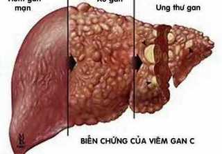 Khoảng 4% dân số Việt Nam bị phơi nhiễm virus viêm gan C