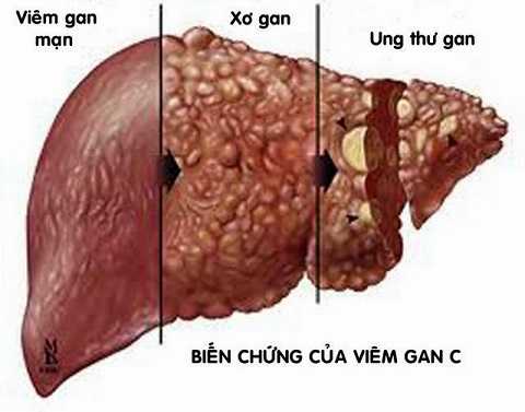 4% dân số Việt Nam bị viêm gan C