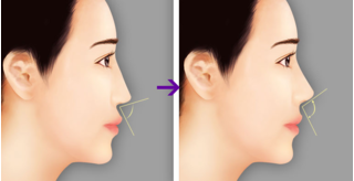 Nâng mũi Hàn Quốc – Giải pháp khắc phục mũi thấp và tẹt