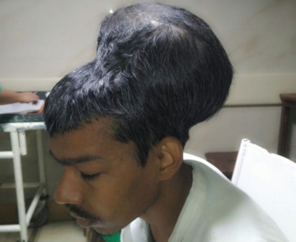 Người đàn ông mang khối u não có kích cỡ to hơn cả đầu. Ảnh: BBC