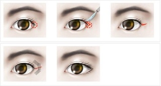 Phẫu thuật kéo dài mắt tạo vẻ to tròn, cân đối và hài hòa