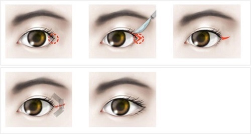 phẫu thuật kéo dài mắt