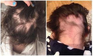 Bệnh lạ khiến cô gái 19 tuổi lần lượt rụng cả tóc lẫn lông mày