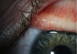 Kinh dị loài giun lạ ký sinh trong mắt người có thể gây mù
