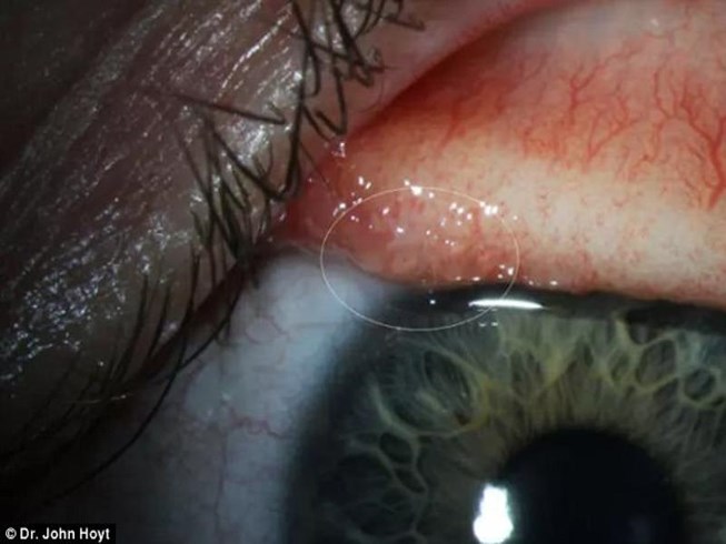 loài giun lạ ký sinh trong mắt có thể gây mù lòa. 
