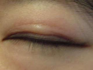 Kĩ thuật phẫu thuật mắt sụp mí Hàn Quốc