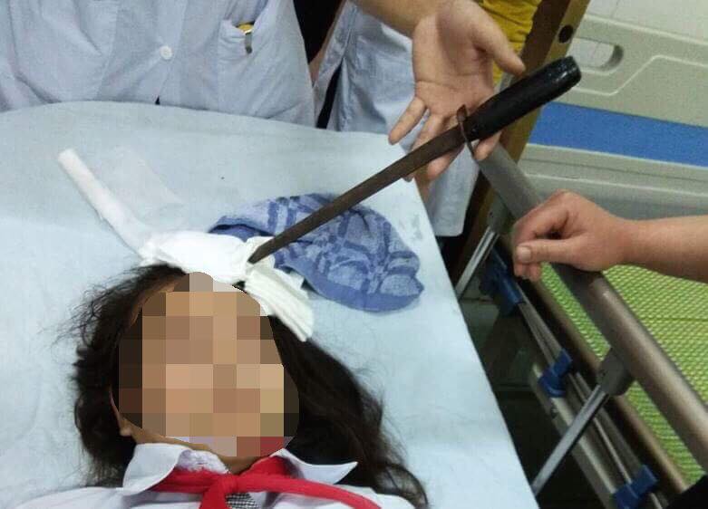 Hà Nam: Nữ sinh 14 tuổi bị bạn cùng lớp phi dao cắm thẳng trán