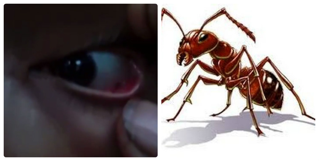 Bé gái bị hàng chục con kiến làm tổ trong mắt gây đau đớn nặng
