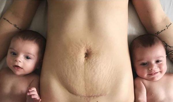 Đây là cách bà mẹ hai con nghĩ về vết bụng rạn sau sinh