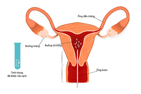 tìm hiểu về thụ tinh ống nghiệm IUI