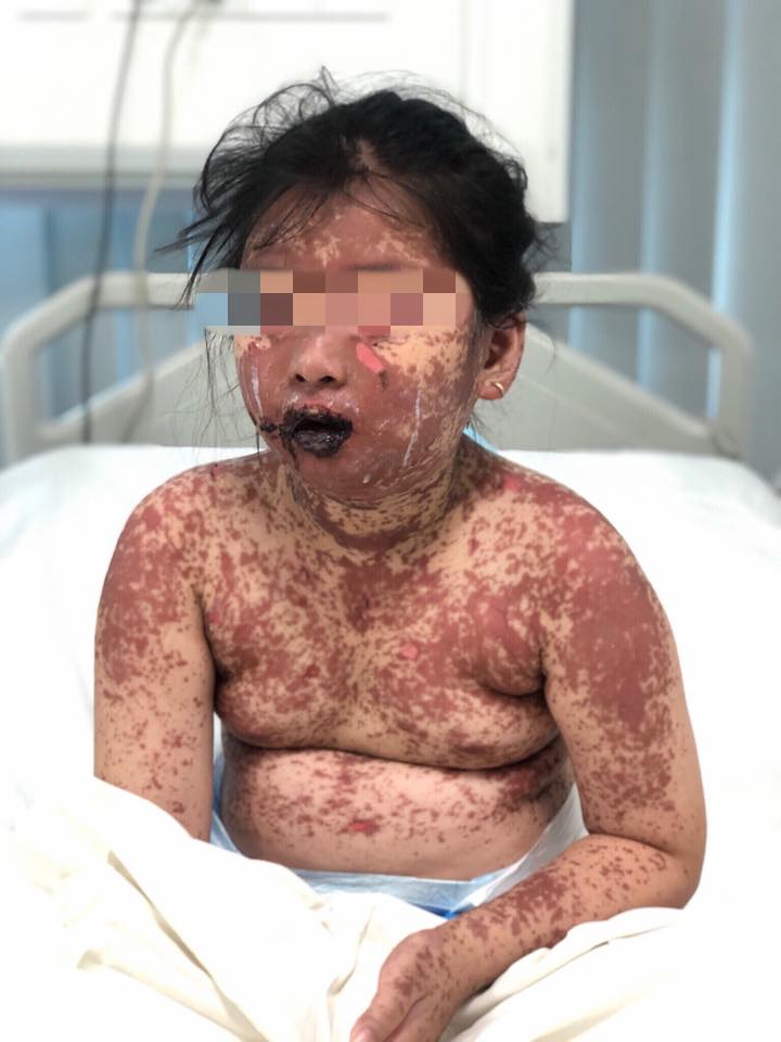 Bé gái 7 tuổi bị bỏng toàn thân bởi dùng thuốc ở phòng khám tư