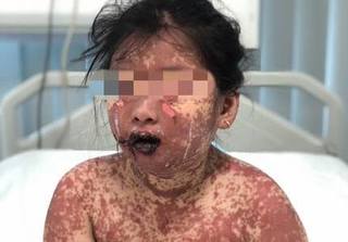 Bé gái 7 tuổi bị bỏng toàn thân vì dùng thuốc ở phòng khám tư
