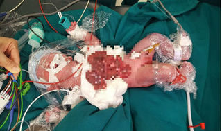 Tội nghiệp 2 bé sơ sinh vừa chào đời lộ nội tạng ngoài thành bụng