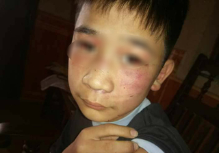 Bé trai 14 tuổi bị bố đẻ và mẹ kế đánh bầm tím toàn thân, tụ máu ở mắt