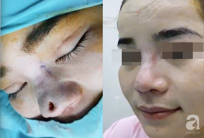 Cô gái 22 tuổi ở Bạc Liêu bị hủy hoại dung nhan vì đi nâng mũi bằng chỉ