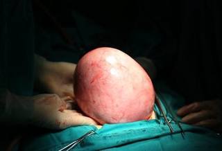 Phẫu thuật thành công khối u trong ổ bụng nặng 2kg