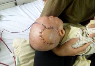 Ngã từ trên giường xuống đất, bé 9 tháng tuổi bị lún sọ não