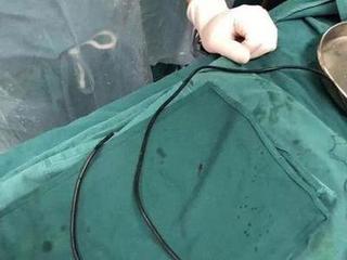 Ca mổ đặc biệt để rút 1m dây cáp khỏi dương vật người đàn ông