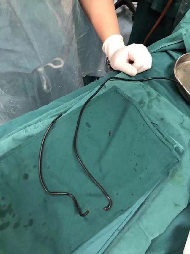 Ca mổ kỳ lạ rút 1m dây cáp khỏi dương vật người đàn ông