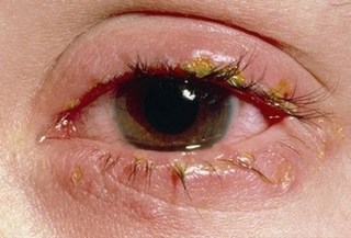 Chữa bệnh đau mắt bằng mật ong, nên hay không?