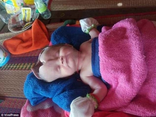 Bé gái 2 tháng tuổi bị khuyết não và hộp sọ bẩm sinh chống chọi tử thần từng giây