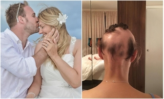 Cô dâu rụng tóc đến trụi đầu vì lo chuẩn bị đám cưới trọng đại