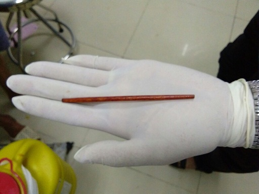 bác sĩ gắp dị vật là một chiếc đũa dài 12cm từ dương vật của nam bệnh nhân