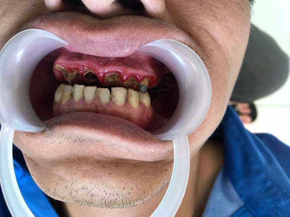 Bọc răng sứ kém chất lượng có nguy cơ hỏng răng vĩnh viễn