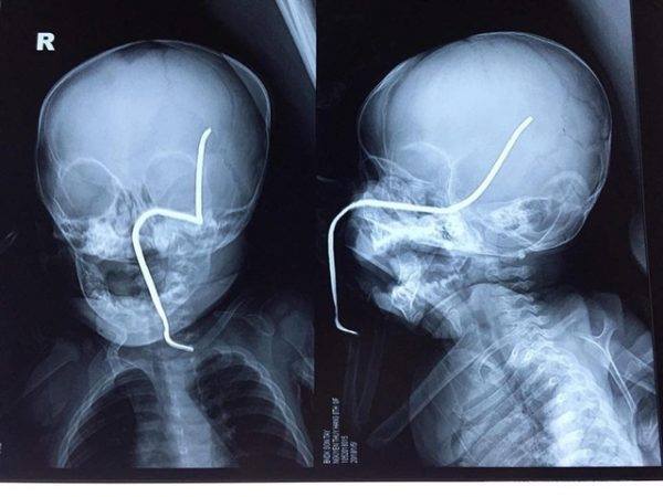 Phẫu thuật thành chông cho bé gái 8 tháng tuổi bị thanh sắt đâm xuyên má, thủng hộp sọ