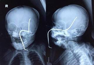 Hà Nội: Bé gái 8 tháng tuổi bị thanh sắt xuyên má, thủng hộp sọ