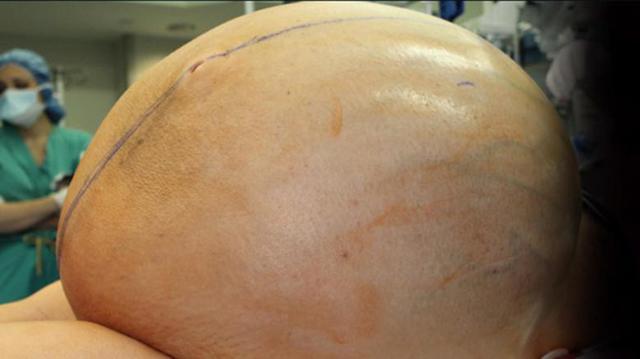 12 bác sĩ toát mồ hôi cắt khối u buồng trứng dài 1m, nặng 60 cân