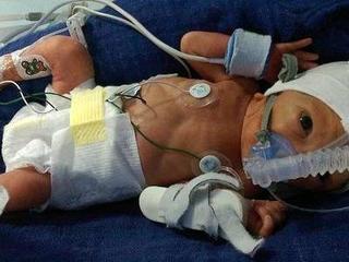 Vỡ ối non khi chỉ mới 18 tuần, cả mẹ và con đều sống sót đầy kì tích