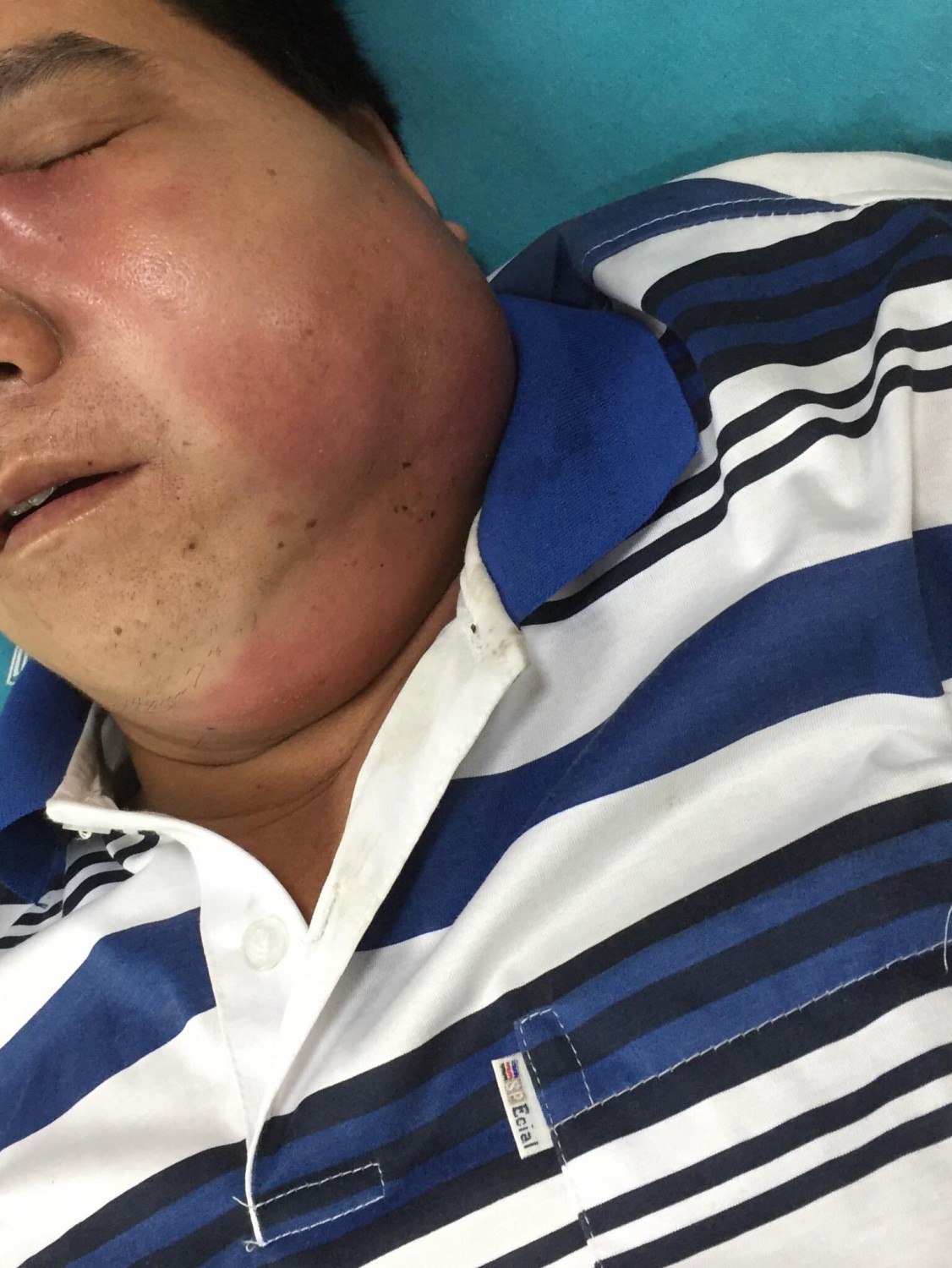 bệnh nhân bị biến dạng khuôn mặt vì tự ý chữa viêm họng tại nhà  2