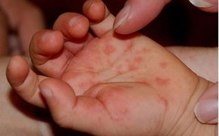 Bệnh nhi tay chân miệng ngày một gia tăng, bác sỹ cảnh báo những dấu hiệu sớm cha mẹ cần biết