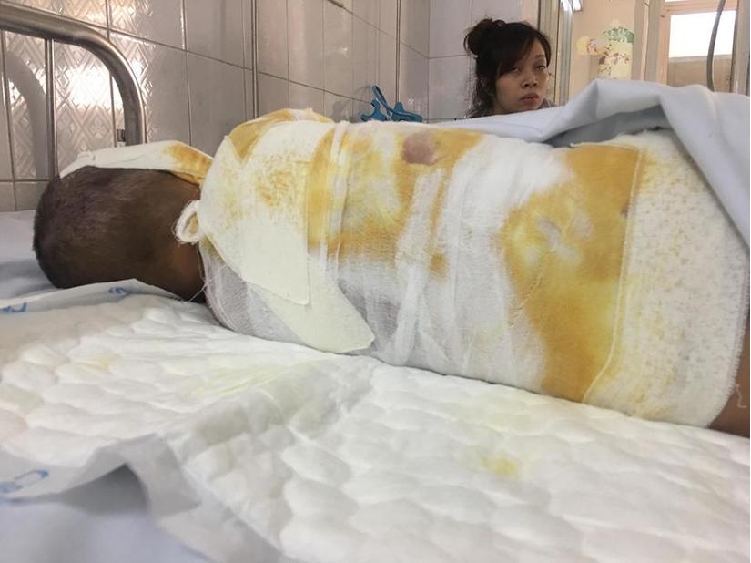 Lào Cai: Ngã vào đống rấm, bé trai 4 tuổi bị bỏng nặng2