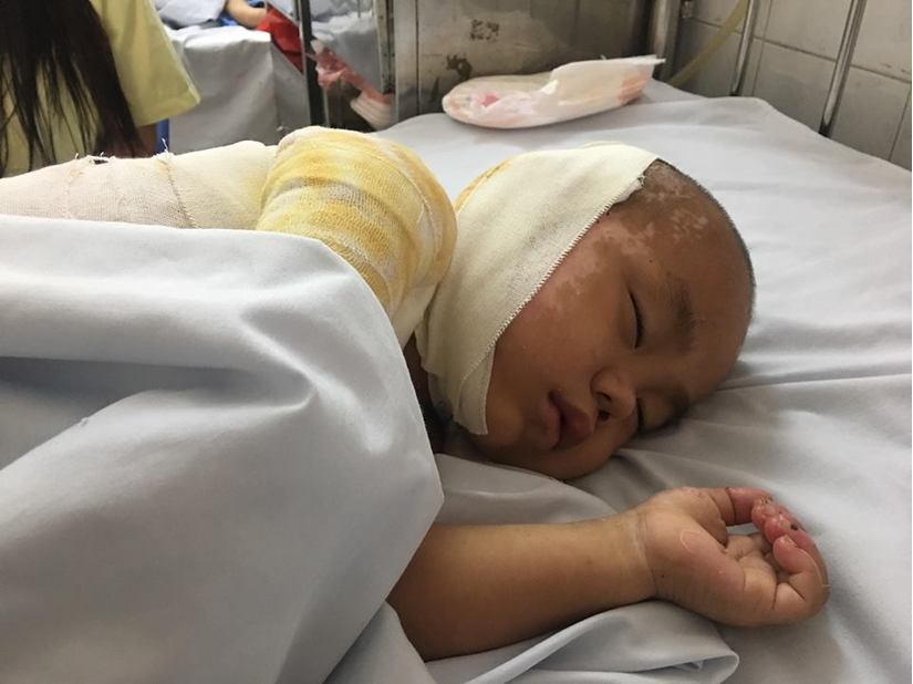 Lào Cai: Ngã vào đống rấm, bé trai 4 tuổi bị bỏng nặng