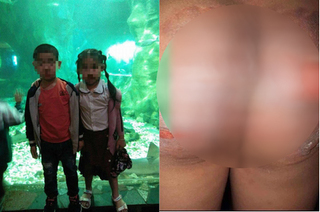 Hà Nội: Hai cháu bé bị bỏng nặng vì bà hàng xóm hắt nước luộc bầu vào người