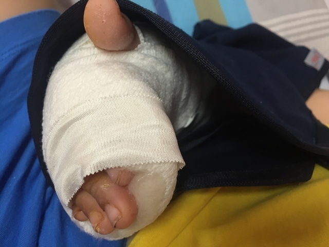 Bé trai 6 tuổi bị đứt gân, đứt động mạch khi ngã vào tủ kính