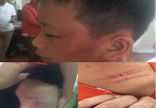 Nghệ An: Sẽ đưa cháu bé 12 tuổi bị mẹ kế bạo hành đi giám định thương tật