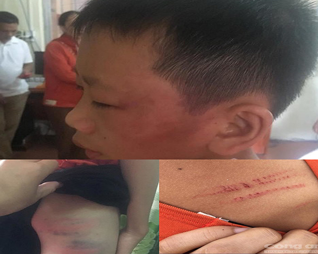 Nghệ An: Nghi vấn nữ giáo viên bạo hành con riêng của chồng