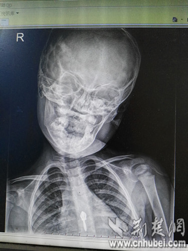 Trẻ bị biến dạng xương cổ do xem điện thoại, biến dạng xương cổ