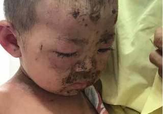 Bé 2 tuổi bị viêm loét, chảy mủ toàn thân vì tắm nước lá