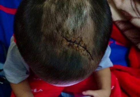 Bé trai 3 tuổi nghi bị cha dượng bạo hành dã man