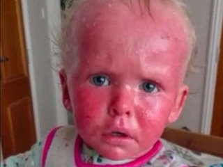 Bệnh vảy nến khiến da của bé 2 tuổi luôn ửng đỏ như bốc cháy