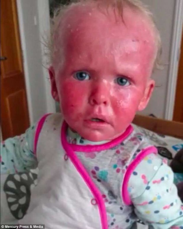 Bệnh vảy nến khiến da của bé 2 tuổi luôn ửng đỏ như bốc cháy