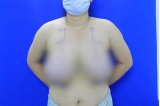 Nữ bệnh nhân có bộ ngực khủng gần 4kg, mỗi lần mang thai lại bị tăng gấp đôi